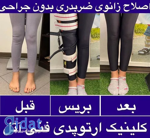 پای ایکس (ضربدری) چیست؟ روش‌های درمان آن